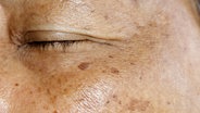 Nahaufnahme des Gesichts einer älteren Frau mit Pigmentflecken. © panthermedia Foto: rosedepositmyphotos