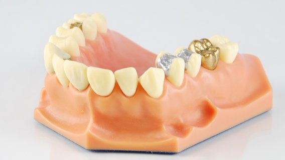 Ein Zahnmodell mit Amalgamfüllungen © Colourbox Foto: Luis Alvarenga