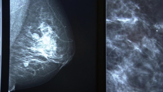 BrustkrebsVorstufe OP bei DCIS empfohlen NDR.de Ratgeber Gesundheit