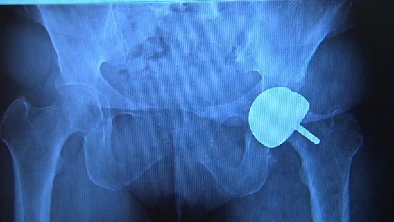 Künstliche Hüftprothese im Röntgenbild  