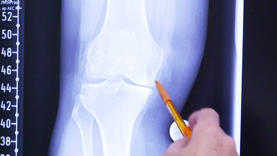 Hand mit Stift zeigt auf eine Röntgenaufnahme des Kniegelenks. © Screenshot 