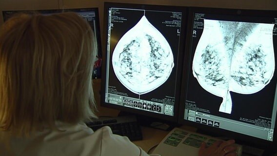 Monitor zeigt das Ergebnis einer Mammographie.  