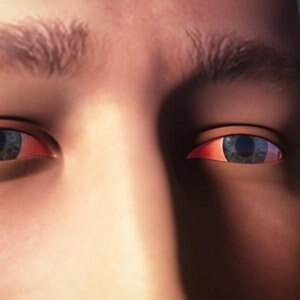 Woher Kommen Rote Augen Ndr De Ratgeber Gesundheit