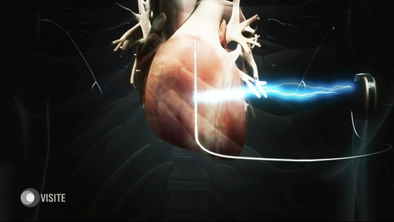 Herzdefibrillator.  
