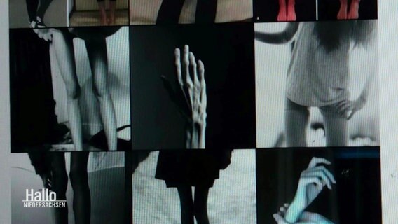 Verschiedene schwarz-weiß Aufnahmen von Armen und Beinen extrem dünner Menschen. © Screenshot 
