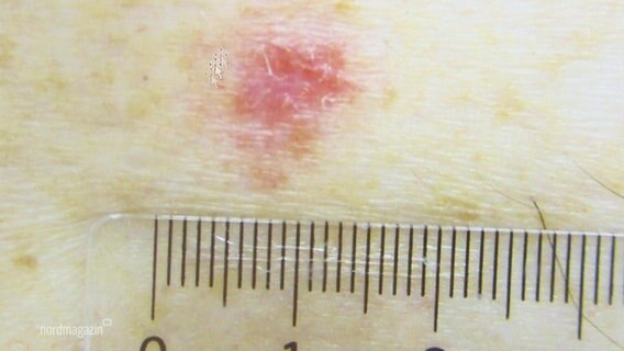 Eine Krebserkrankung auf der Haut, zustäzlich ein Millimetermaß. © Screenshot 