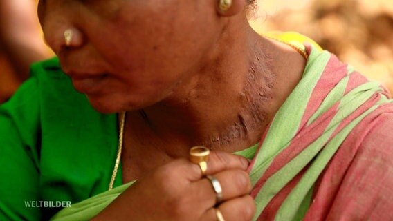 Eine Frau mit dunklerer Hautfarbe entblößt eine längere Narbe an ihrem Hals. © Screenshot 