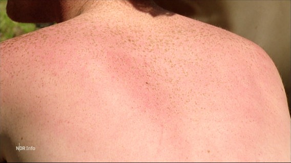Ein leicht rötlicher Rücken mit Sommersprossen. © Screenshot 