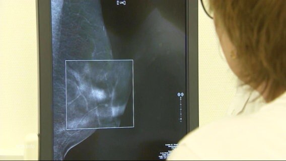 Blick über die Schulter einer Ärztin auf einen Bildschirm der eine Mammografie-Aufnahme zeigt. © Screenshot 