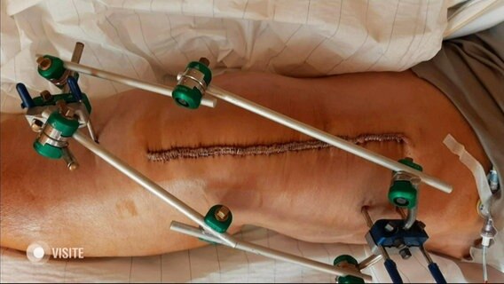 Ein Knie nach einer Operation. © Screenshot 