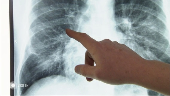 Jemand deutet mit dem Finger auf eine Röntgen-Aufnahme eines Brustkorbs. © Screenshot 