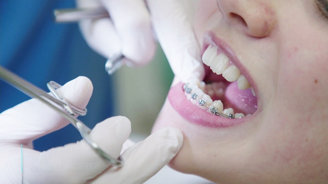 Nahaufnahme: Eine Person mit Zahnspange öffnet den Mund. Hände in medizinischen Handschuhen und mit Instrumenten führen eine Untersuchung durch. 