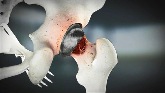 Eine Computeranimation zeigt eine Hüftprothese, der das umliegende Gewebe entzündlich macht.  