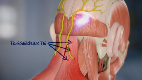 Schematische Darstellung: Triggerpunkte im Nackenbereich © NDR 