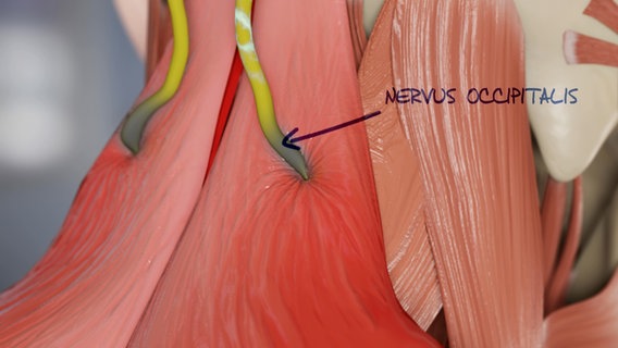 Schematische Darstellung: Der Nervus Oxibitalis im Nacken © NDR 