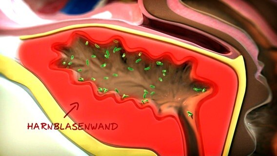 Schematische Darstellung: Bakterien heften sich an die Blasenschleimhaut und lösen Entzündung aus © NDR 