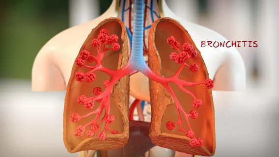 Schematische Darstellung: entzündete Bronchien. © NDR 
