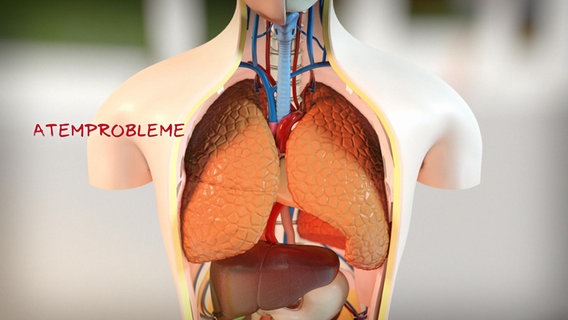 Schematische Darstellung der Lunge in einem Torso. © NDR 