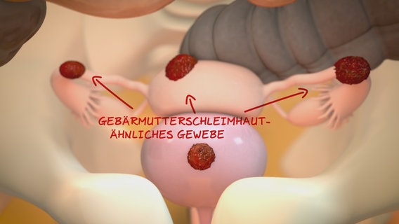 Schematische Darstellung: Gebärmutterschleimhaut-ähnliches Gewebe siedelt sich im Bauchraum an. © NDR 