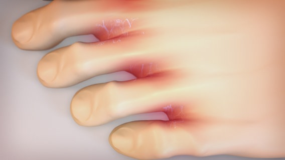 Schematische Darstellung eines Fußes mit Fußpilz-Infektion zwischen den Zehen © NDR 