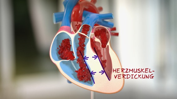 Schematische Darstellung des verdickten Herzmuskels © NDR 