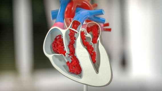 Schematische Darstellung des verringerten Blutflusses bei verdicktem Herzmuskel © NDR 