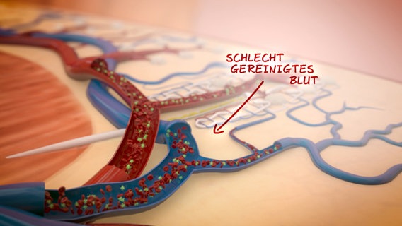 Schematische Darstellung: Nierengefäße mit Schadstoffen im Blut. © NDR Foto: tonic trix