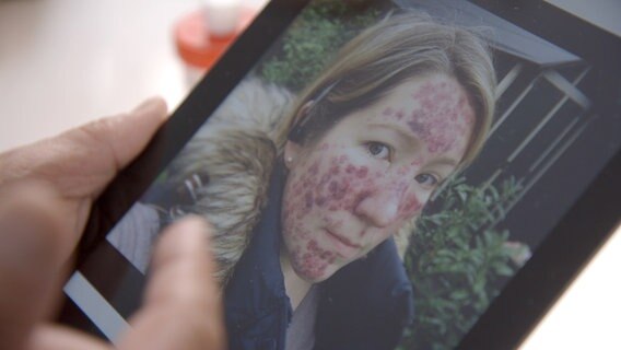 Bild einer Frau mit Pusteln im Gesicht. © NDR 