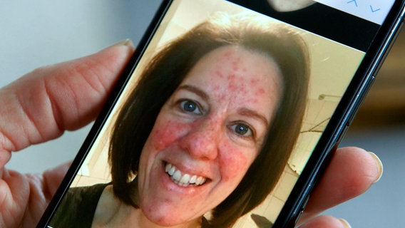 Mobile phone photo of a smiling woman with many wounds on her face.  © NDR 