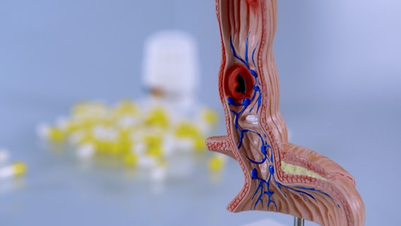 Modell einer Speiseröhre mit Krebsgeschür, im Hintergrund Säureblocker-Tabletten. © NDR Foto: Moritz Schwarz/Oliver Zydek