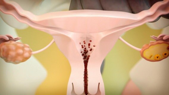Schematische Darstellung: Gebärmutter bei Monatsblutung © NDR 