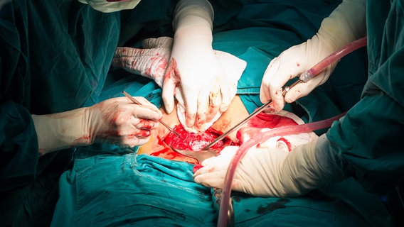 Chirurg operiert an offenem Bauchraum © fotolia Foto: samrith