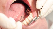 Zahnarzt untersucht Zahnfleich eines Patienten © fotolia.com Foto: K.-U. Häßler