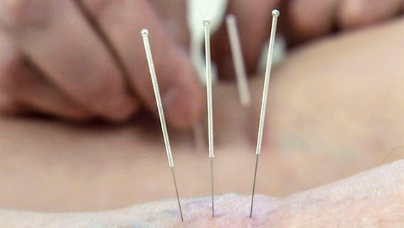 Akupunkturnadeln auf der Haut. © NDR/Labo M GmbH 