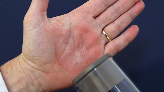 Rotes Mal auf einer Handfläche illustriert, wie der durch eine Vakuumpumpe erzeugte Unterdruck die Durchblutung fördert. © NDR 