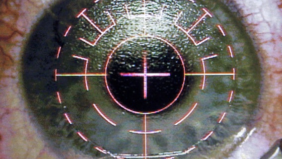 Auge während einer Laser-Operation. © picture-alliance Foto: Charles Rex Arbogast