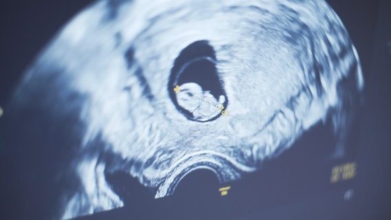 Ultraschallbild eines Embryos © NDR Foto: Screenshot