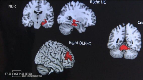 MRT-Aufnahmen vom Gehirn eines Studienteilnehmers  