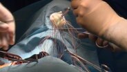 Bei einer Operation wird eine künstliche Herzklappe eingesetzt. © NDR 