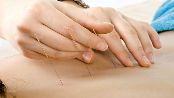 Akupunkturnadeln werden in einen Rücken gestochen © Colourbox Foto: -