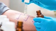 Allergietestmittel wird auf einem Arm getropft. © Fotolia.com Foto: Alexander Raths