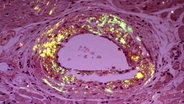 Kreislaufsystem Amyloidose Ablagerung von Proteine in Blutgefäß, Mikroaufnahme Querschnitt. © picture-alliance / OKAPIA KG, Germany Foto: Gladden W. Willis