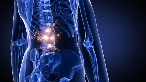 Rückenschmerzen Anhand einer Illustration dargestellt. © fotolia Foto: Sebastian Kaulitzki