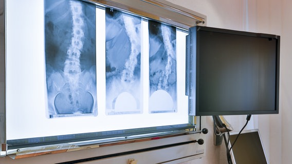 Röntgenaufnahmen einer Wirbelsäule © fotolia Foto: digitalefotografien