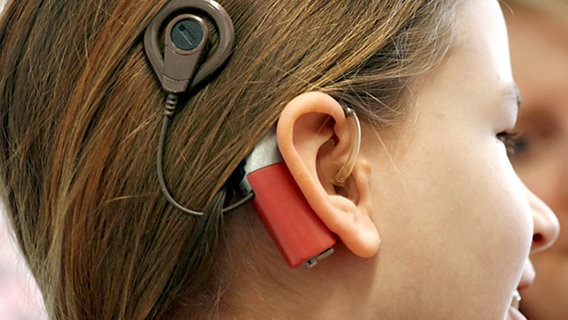 Mädchen mit einem Cochlear Implantat © picture-alliance/ dpa 