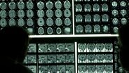 Schichtaufnahmen eines Gehirns, die mit einem Magnetresonanztomographen aufgenommen worden sind. © picture-alliance / dpa 