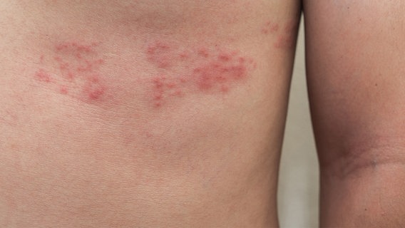Gürtelrose in Form von roten Pusteln zeigt sich auf dem Brustkorb eines jungen Mannes. © fotolia.com Foto: t0pkul3