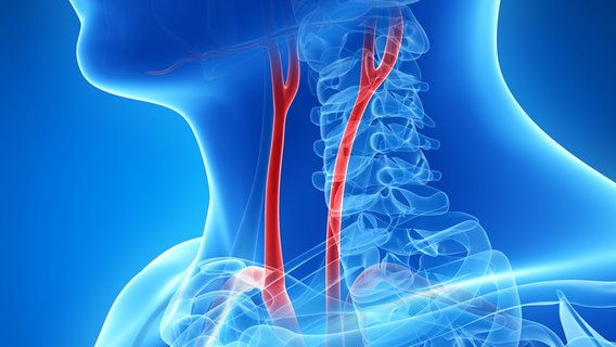 Eine 3D Grafik einer menschlichen Halsschlagader © panthermedia Foto: Eraxion