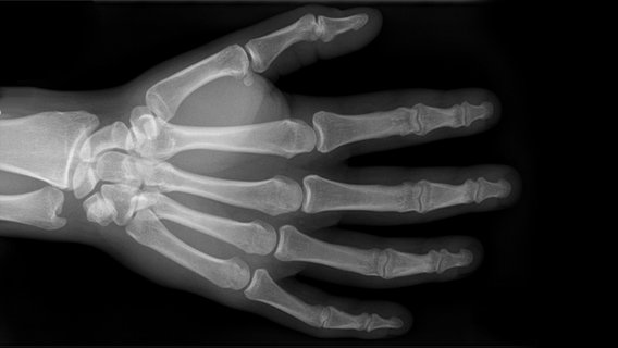 Röntgenaufnahme einer Hand © Hellerhoff 