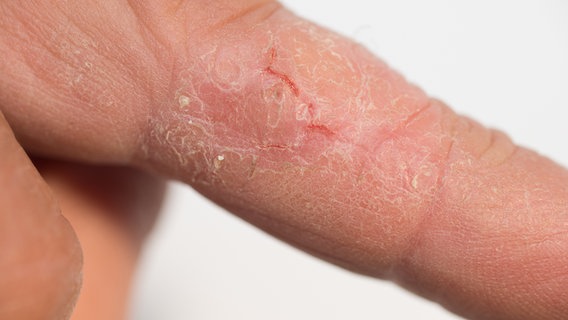 Fissur Mittelfinger links bei extrem trockener Haut. © fotolia.com Foto: casi